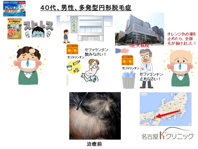 円形脱毛症　病院